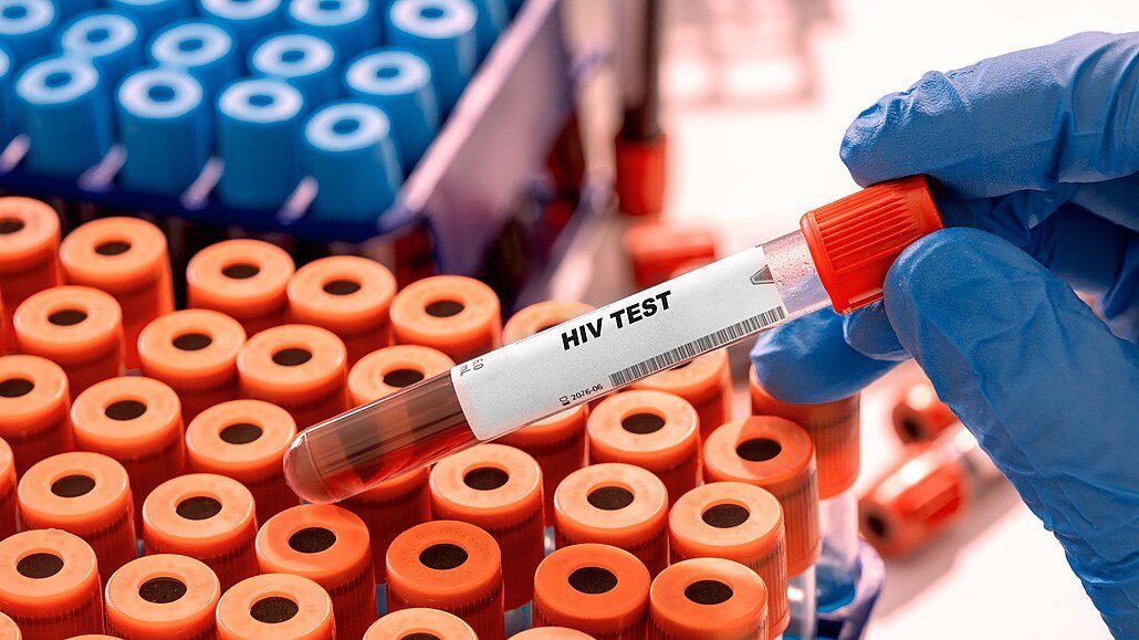 HIV v Česku dál přibývá. Případy nejsou jen ve velkých městech, týkají se i Karlovarského kraje