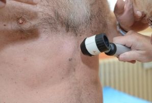 obrázek: Sokolov: V nemocnici opět upozorní na zhoubný melanom kůže