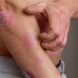 Den otevřené ambulance v Karlovarské nemocnici pro pacienty s lupénkou